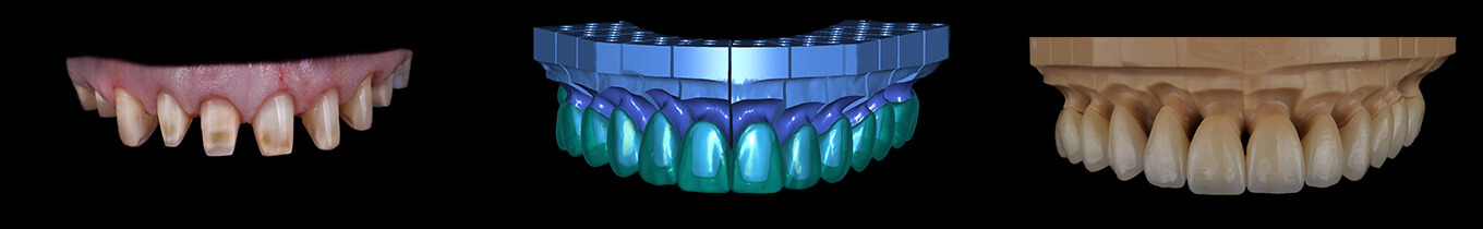 Full Mouth Restoration Dental CE