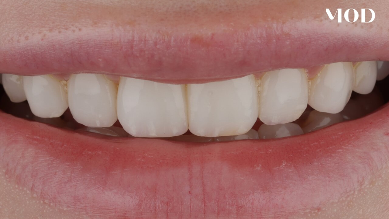 Follow Up Veneer Case