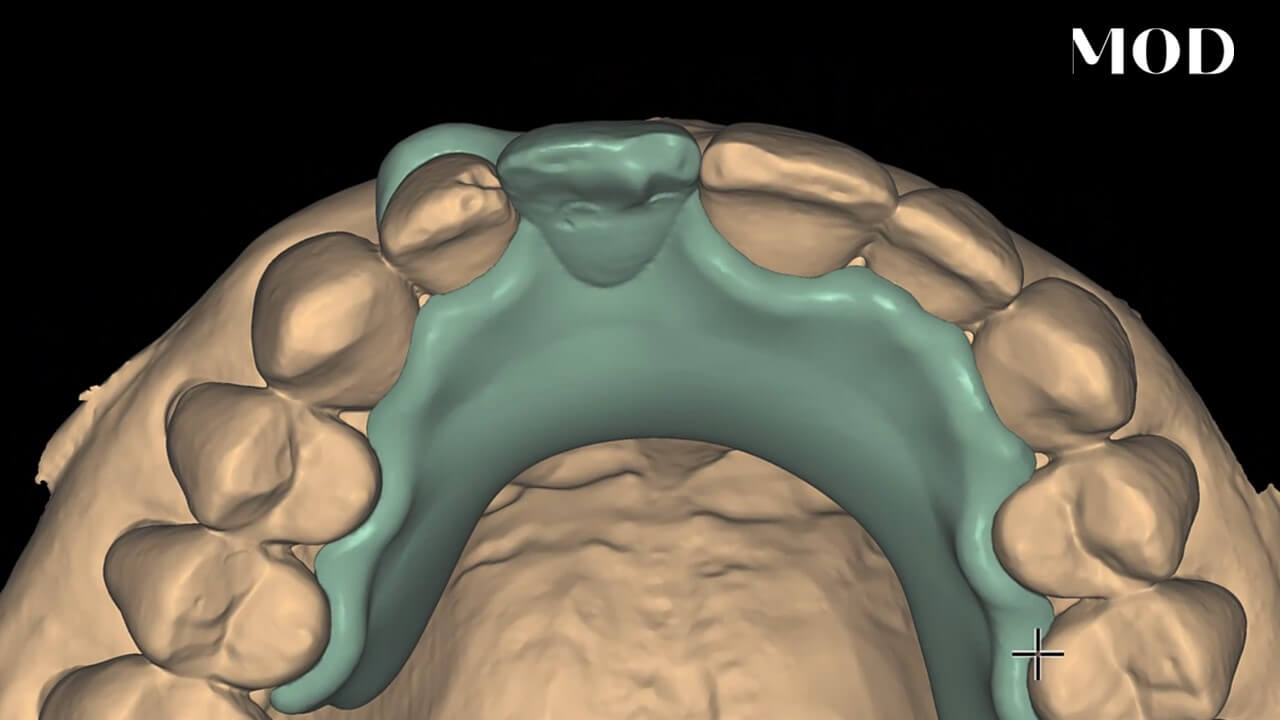 Monolithic Partial Denture Design in exocad