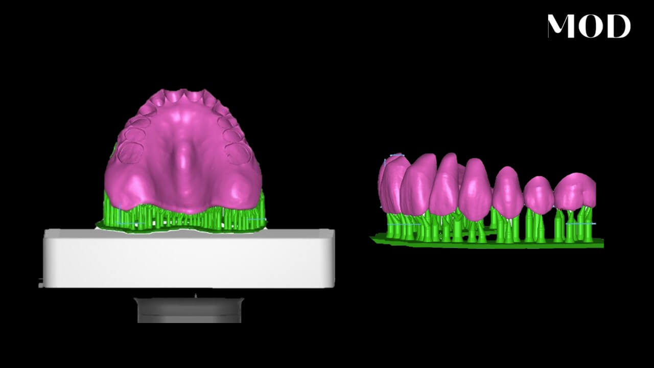 Nesting Dentures