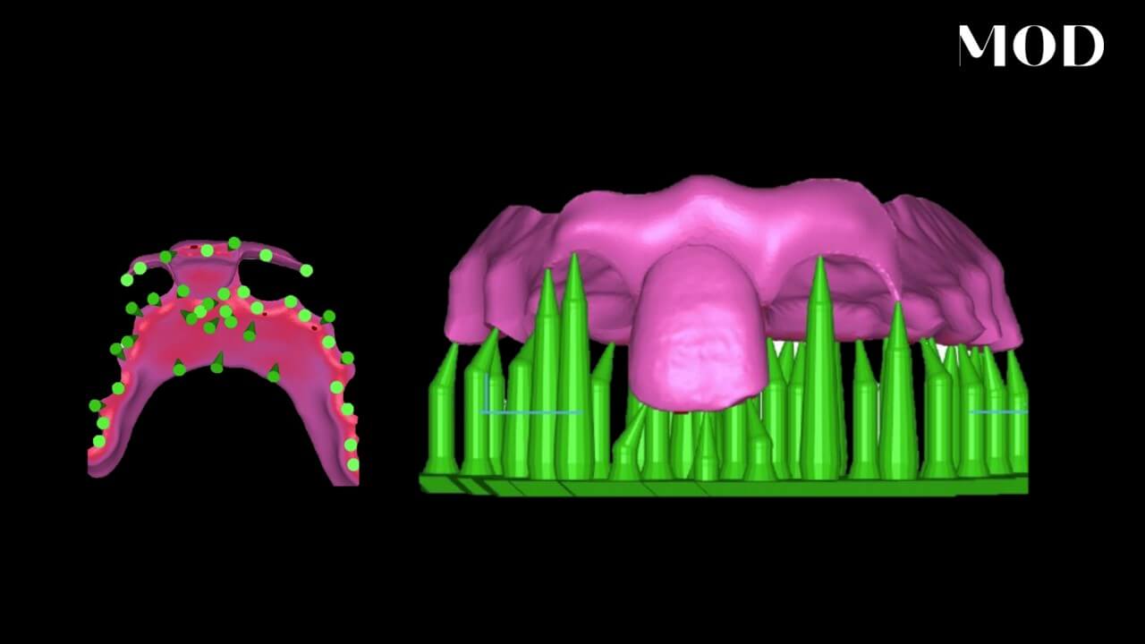 Nesting Partial Dentures