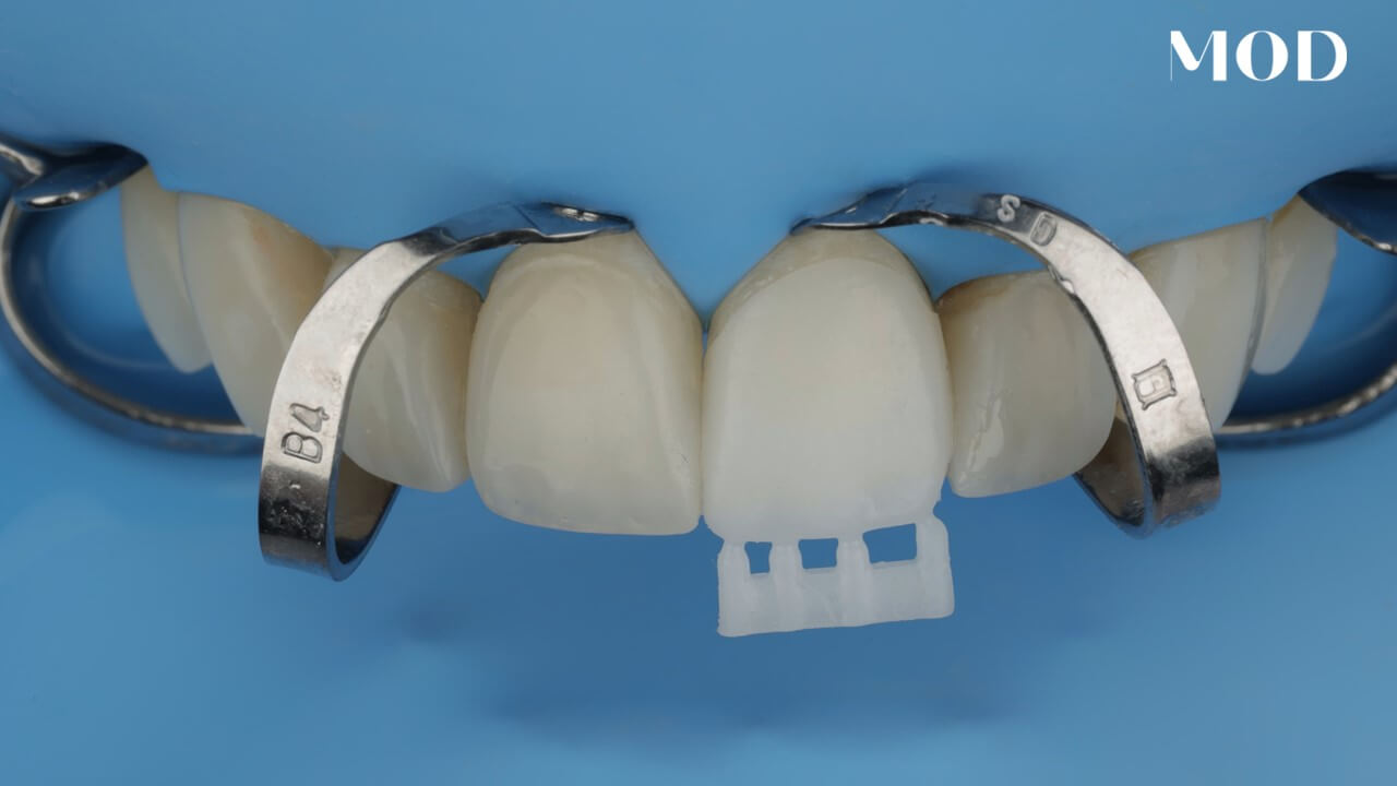 Same Day Single Veneer